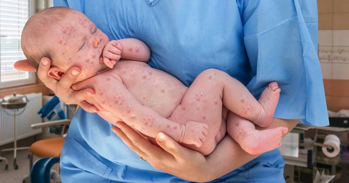 بیماری ها در نوزادان تازه متولد شده